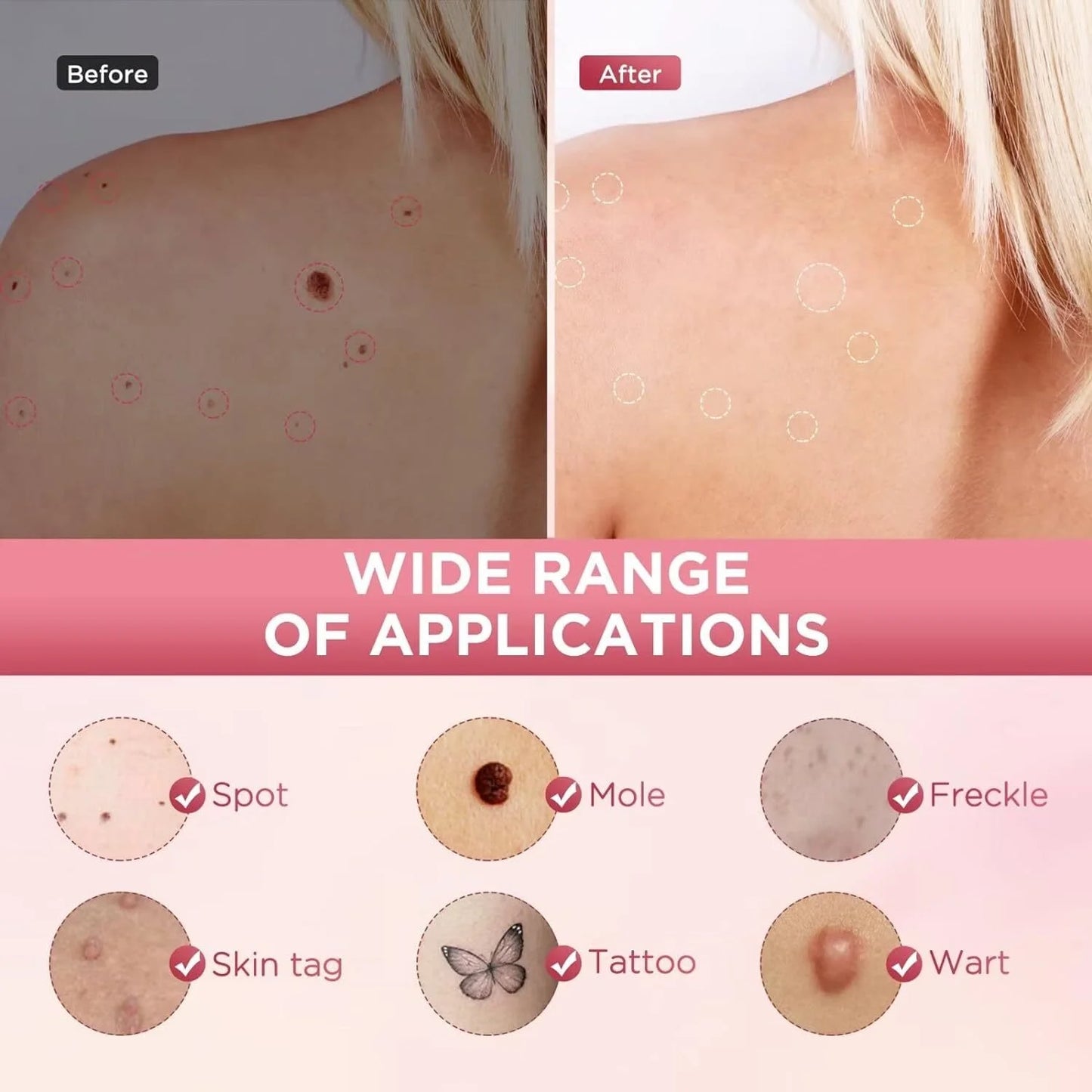 Portable Skin Imperfection Remover