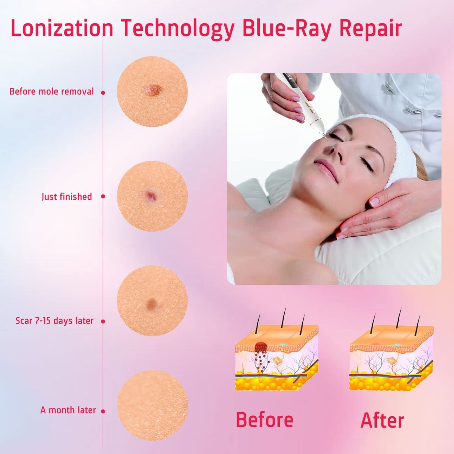Advanced Mole Removal Pen