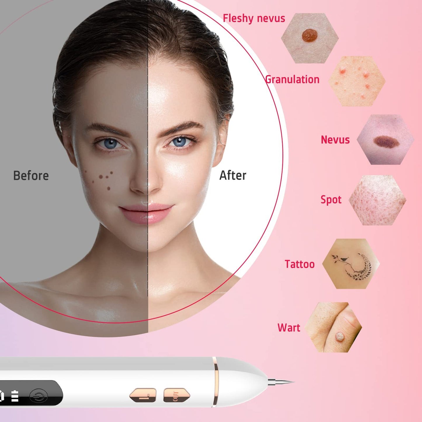 Advanced Mole Removal Pen