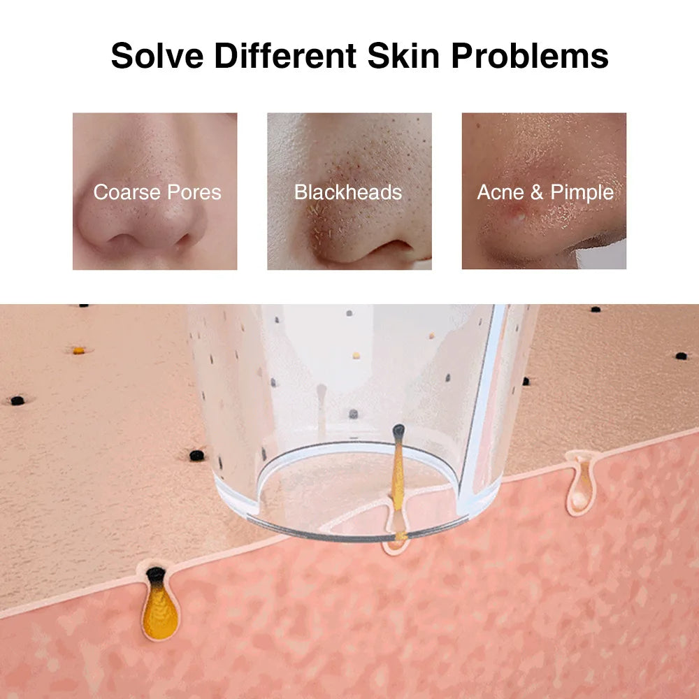 Blackhead Remover Vacuum with Camera